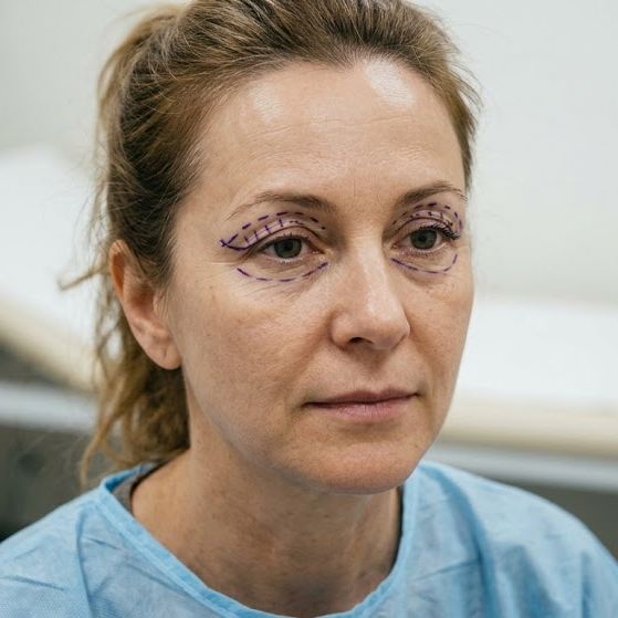 Dott. Bruno Kropp Chirurgo Oculoplastico Roma